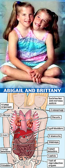 Abigail and Brittany Hensel. Image use for News Reporting by True Strange News. Contact for attribution or removal. https://static.newsi8.com/uploads/2008/04/henseltwins3112_228x589.jpg